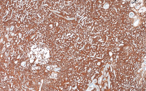 14I1 Meningioma, EMA negative (Case 14) SSTR2A) 3