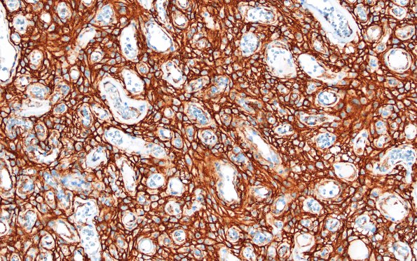 14I3 Meningioma, EMA negative (Case 14) SSTR2A) 1