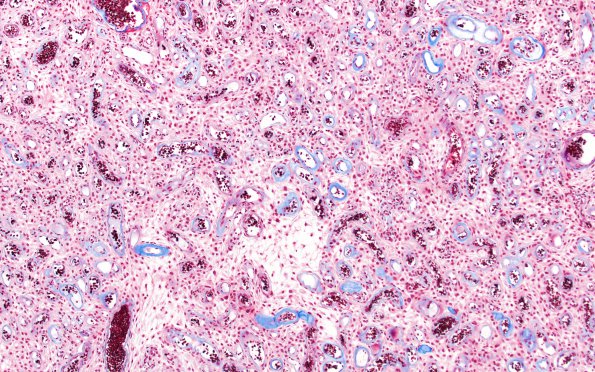 14J Meningioma, EMA negative (Case 14) Trichrome 1