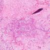 15A1 Meningioma, Angiomatous & Xanthomatous (Case 15) H&E 5