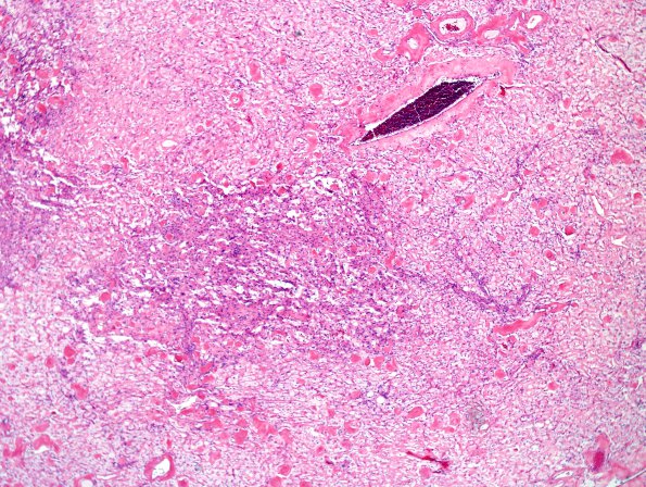 15A1 Meningioma, Angiomatous & Xanthomatous (Case 15) H&E 5