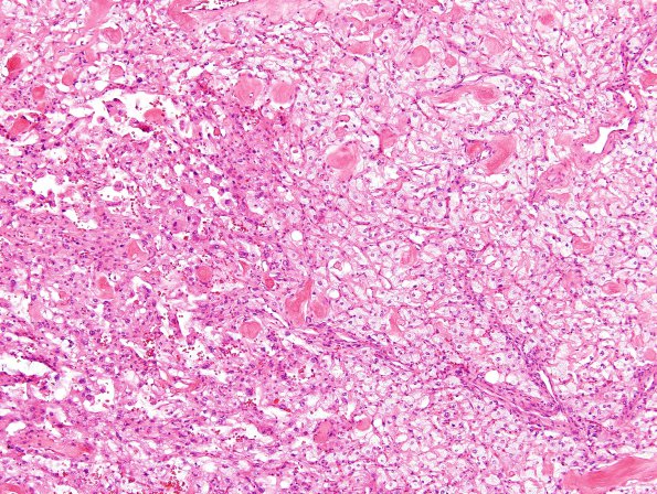 15A2 Meningioma, Angiomatou & Xanthomatous (Case 15) H&E 4