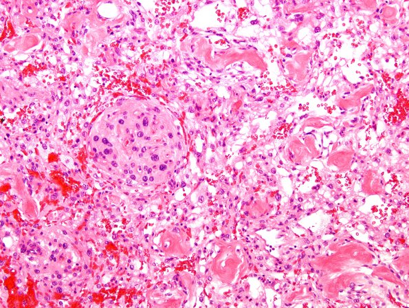 15A3 Meningioma, Angiomatous & Xanthomatous (Case 15) H&E 2