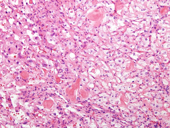 15A4 Meningioma, Angiomatous & Xanthomatous (Case 15) H&E 3