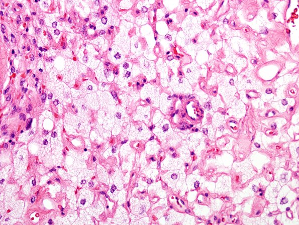 15A5 Meningioma, Angiomatous & Xanthomatous (Case 15) H&E 1