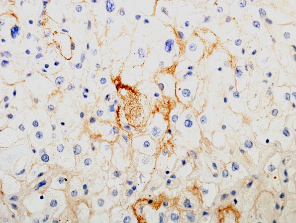 15B1 Meningioma, Angiomatous & Xanthomatous (Case 15) EMA 1