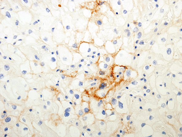 15B2 Meningioma, Angiomatous & Xanthomatous (Case 15) EMA 3