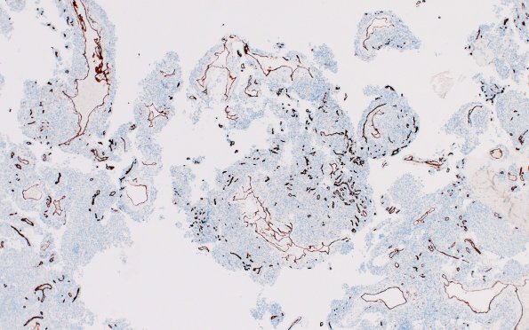 16C Meningioma, angiomatoid (Case 16) CD34 4X