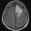 1A1 Meningioma, angiomatous (Case 1) FLAIR - Copy