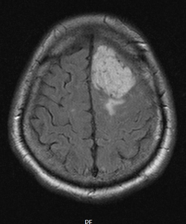 1A1 Meningioma, angiomatous (Case 1) FLAIR - Copy