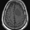 1A2 Meningioma, angiomatous (Case 1) T1 2 - Copy