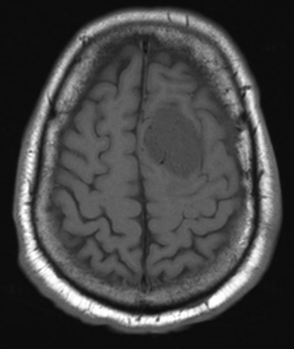 1A2 Meningioma, angiomatous (Case 1) T1 2 - Copy