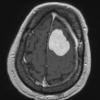 1A3 Meningioma, angiomatous (Case 1) T1W - Copy