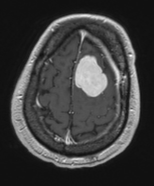 1A3 Meningioma, angiomatous (Case 1) T1W - Copy