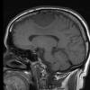 1A4 Meningioma, angiomatous (Case 1) T1 - Copy