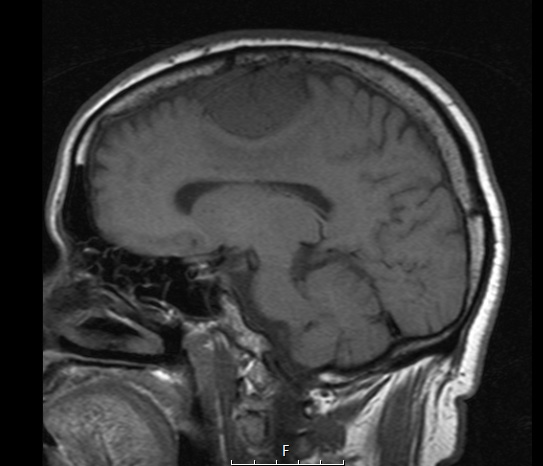 1A4 Meningioma, angiomatous (Case 1) T1 - Copy