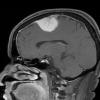 1A5 Meningioma, angiomatous (Case 1) T1W 2 - Copy