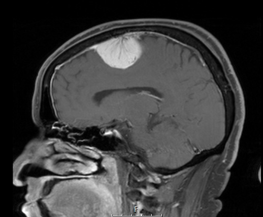 1A5 Meningioma, angiomatous (Case 1) T1W 2 - Copy