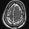 1A6 Meningioma, angiomatous (Case 1) T2W - Copy