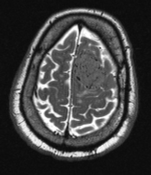 1A6 Meningioma, angiomatous (Case 1) T2W - Copy