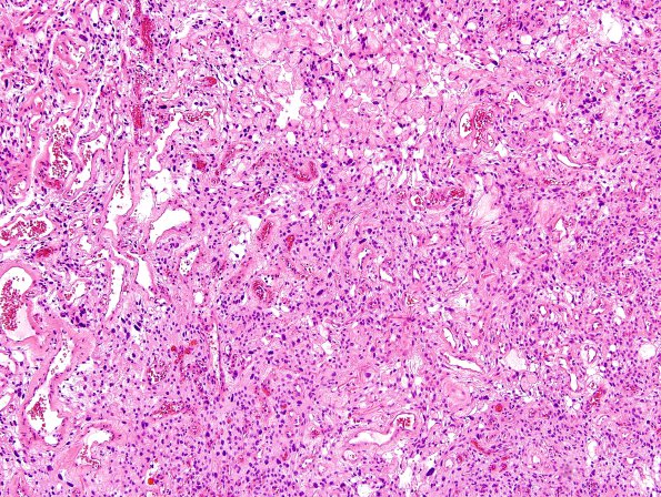 1B1 Meningioma, angiomatous (Case 1) H&E 10.jpg