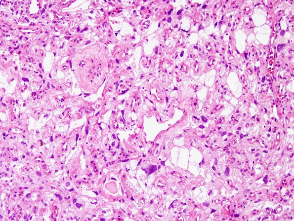 1B2 Meningioma, angiomatous (Case 1) H&E 3.jpg