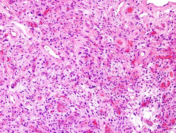 1B3 Meningioma, angiomatous (Case 1) H&E 8.jpg