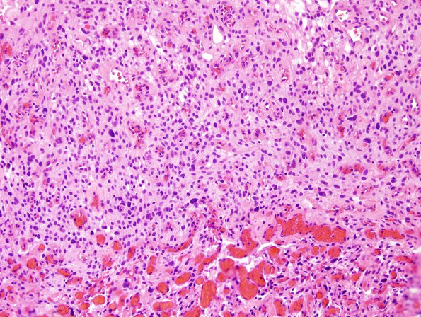 1B4 Meningioma, angiomatous (Case 1) H&E 13.jpg