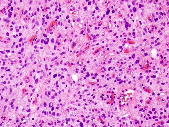 1B5 Meningioma, angiomatous (Case 1) H&E 6.jpg