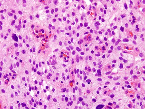 1B6 Meningioma, angiomatous (Case 1) H&E 12.jpg