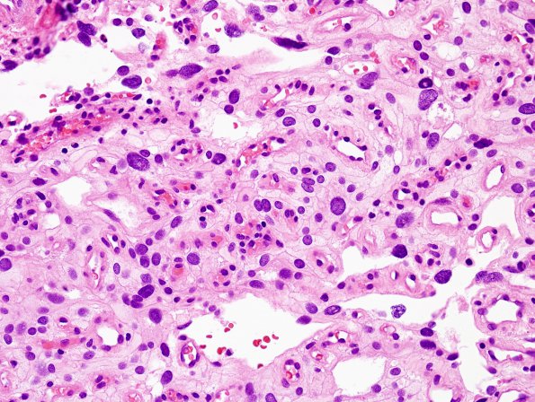 1B7 Meningioma, angiomatous (Case 1) H&E 11.jpg