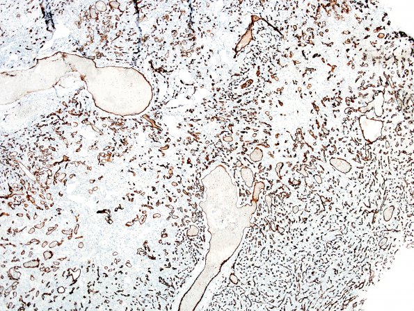 1C1 Meningioma, angiomatous (Case 1) CD34 2.jpg