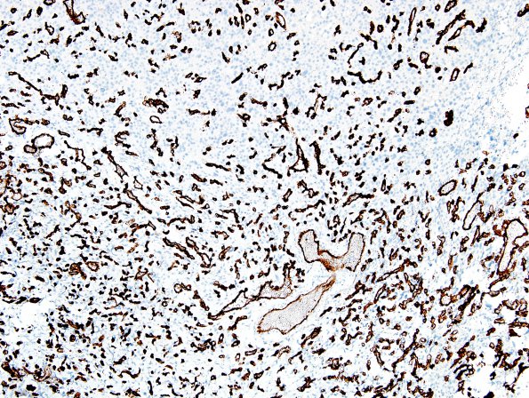 1C2 Meningioma, angiomatous (Case 1) CD34 3.jpg