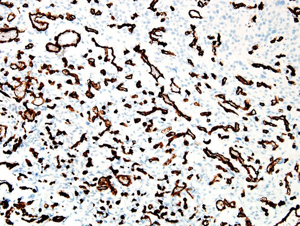 1C3 Meningioma, angiomatous (Case 1) CD34 4.jpg