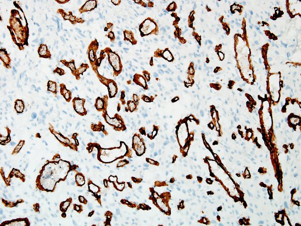 1C4 Meningioma, angiomatous (Case 1) CD34 6.jpg