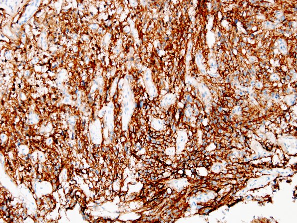 1D1 Meningioma, angiomatous (Case 1) EMA 3.jpg