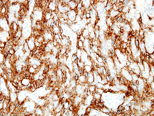 Filename: 1D2 Meningioma, angiomatous (Case 1) EMA 1.jpg