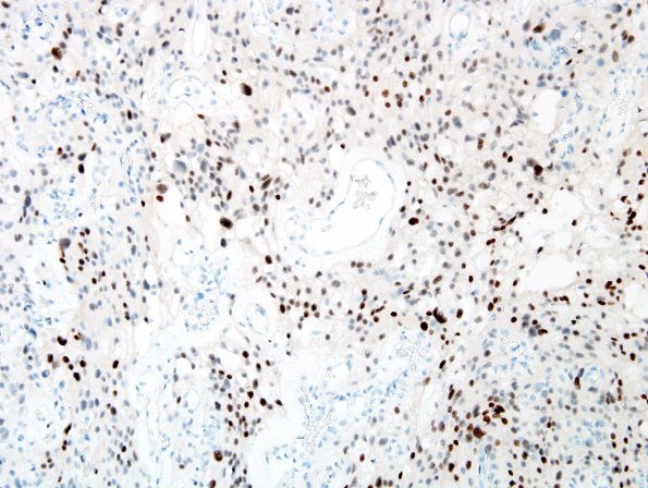 1E1 Meningioma, angiomatous (Case 1) PR 3.jpg