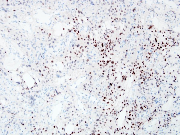 1E2 Meningioma, angiomatous (Case 1) PR 5.jpg