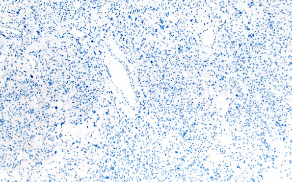 1G1 Meningioma, angiomatous (Case 1) Inhibin 10X