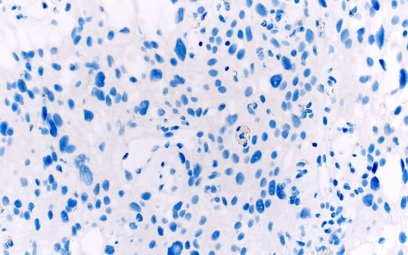 1G3 Meningioma, angiomatous (Case 1) Inhibin 40X