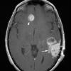 2A1 Meningioma, angiomatous (Case 2) T1W copy - Copy