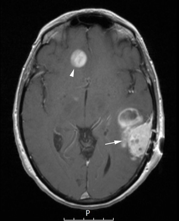 2A1 Meningioma, angiomatous (Case 2) T1W copy - Copy