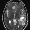 2A2 Meningioma, angiomatous (Case 2) T2W - Copy