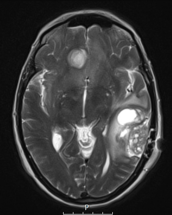 2A2 Meningioma, angiomatous (Case 2) T2W - Copy