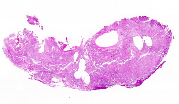 2B1 Meningioma, (Case 2) H&E WM 2