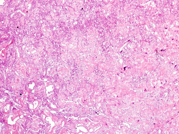 2B2 Meningioma, (Case 2) H&E 3.jpg