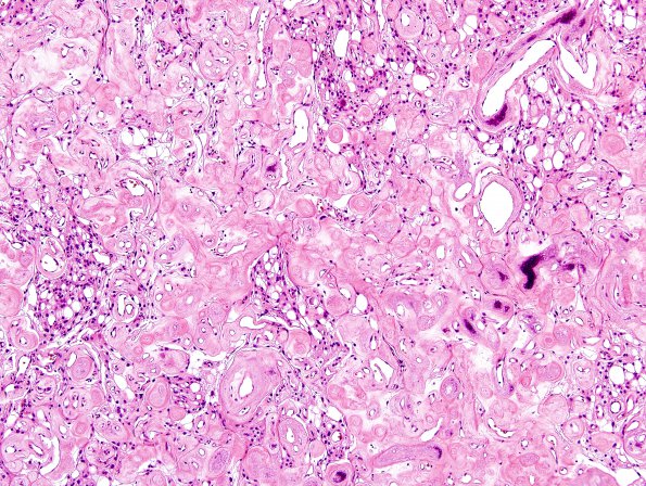 2B3 Meningioma, (Case 2) H&E 4.jpg