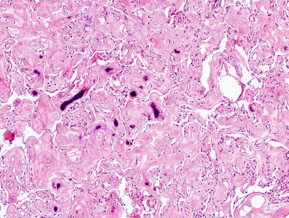 2B4 Meningioma, (Case 2) H&E 2.jpg