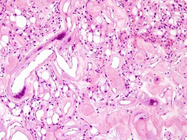 2B5 Meningioma, (Case 2) H&E 5.jpg